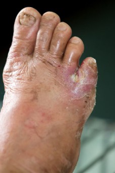 Foot Surgery for Epidermolysis Bullosa by OrangeCountySurgeons